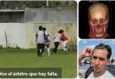 Piden apoyo para cirugía de futbolista lesionado durante partido en Chocamán. Piden apoyo para cirugía de futbolista lesionado durante partido en Chocamán.